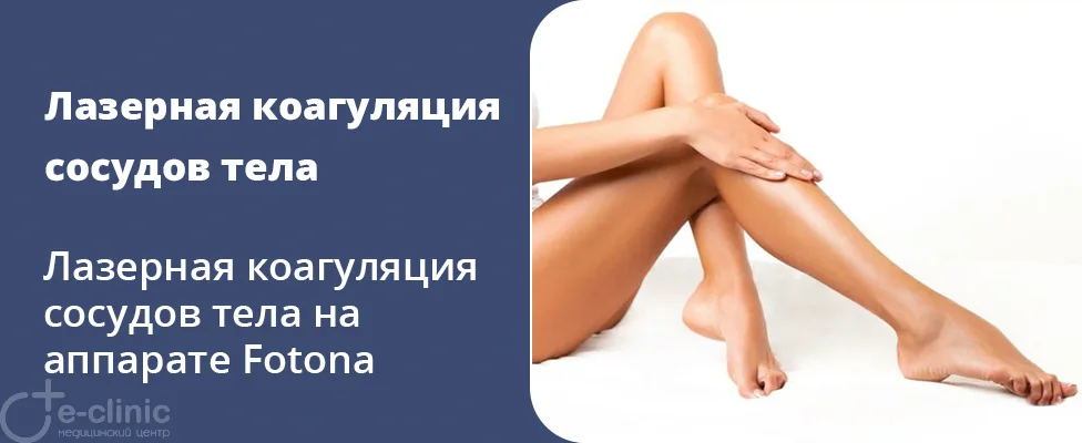Лазерная коагуляция сосудов на аппарате Fotona