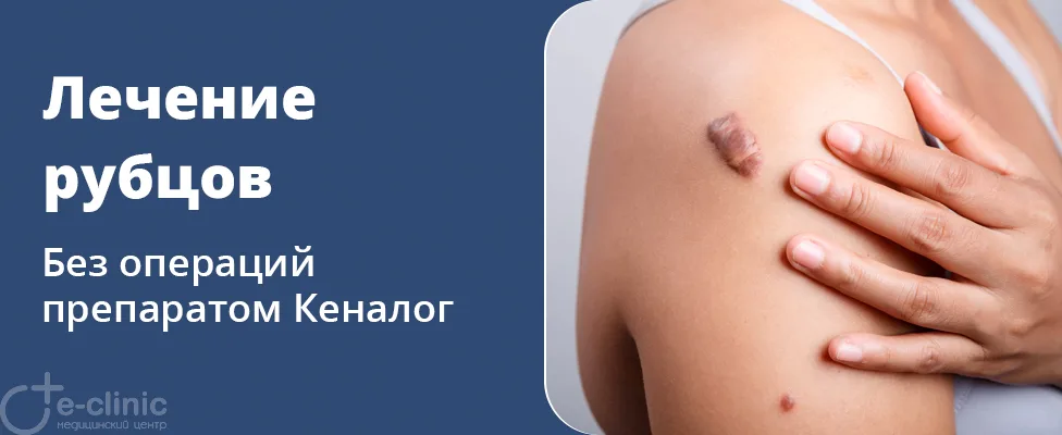 Лечение келоидных рубцов препаратом Кеналог