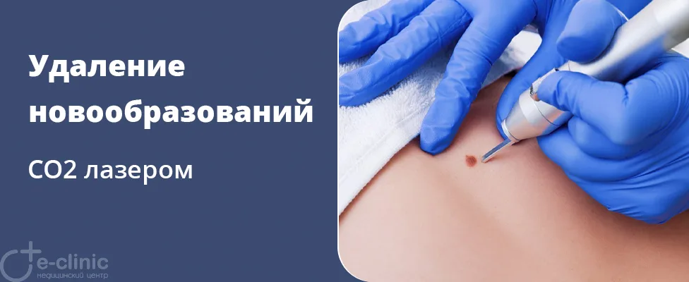 Лазерное СО2 удаление доброкачественных новообразований кожи (родинки, папилломы, кератомы и др.)