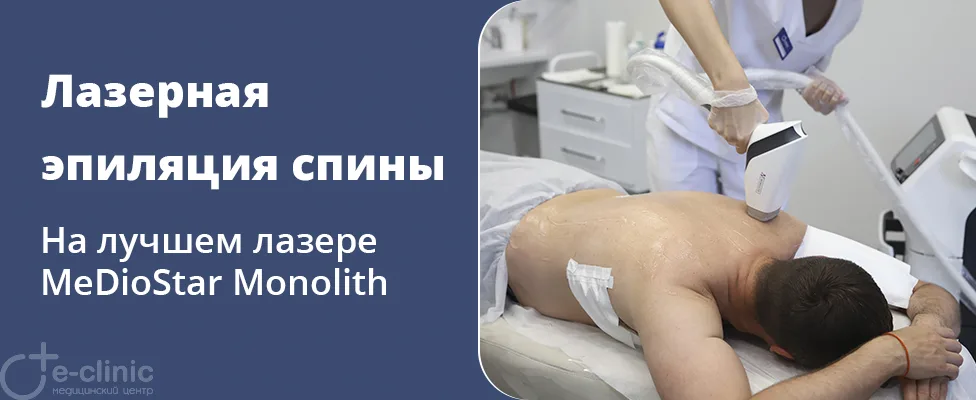 Лазерная эпиляция спины