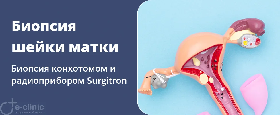 Биопсия шейки матки