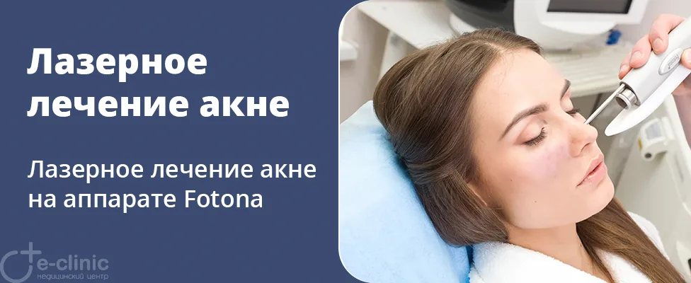 Лазерное лечение акне на аппарате Fotona