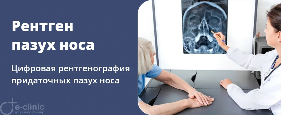 Рентген околоносовых пазух носа