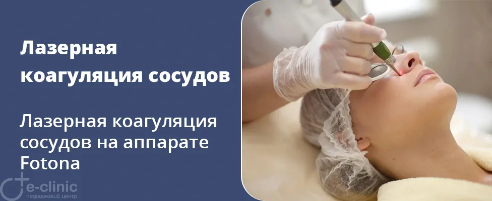 Лазерная коагуляция сосудов лица на аппарате Fotona