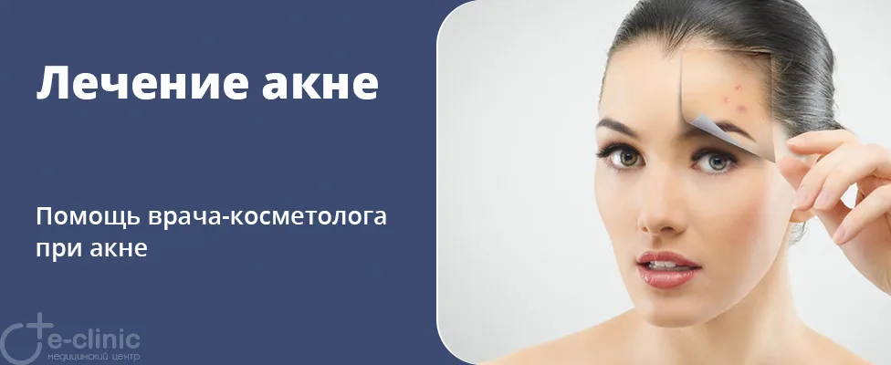 Лечение акне