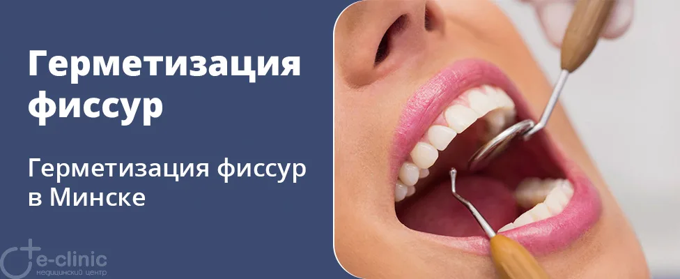 Герметизация фиссур