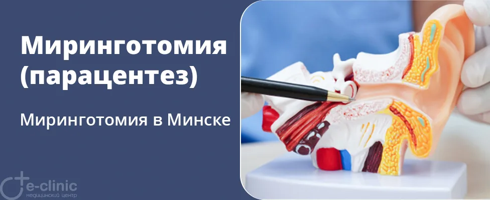 Миринготомия (парацентез)