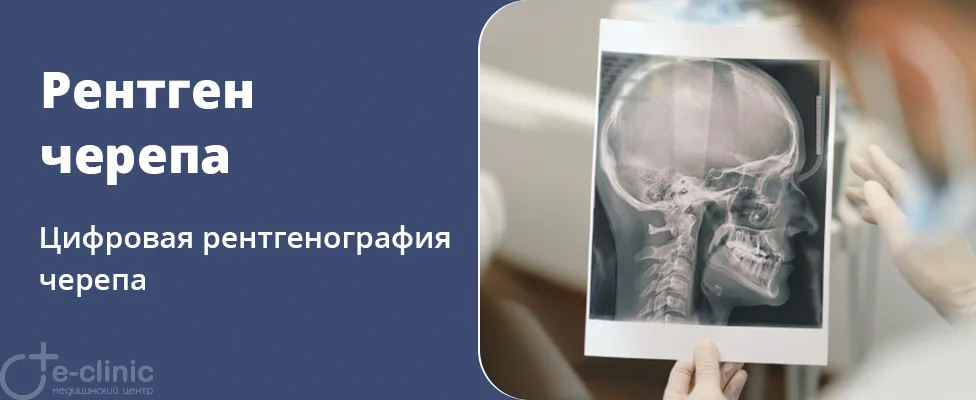 Рентген черепа