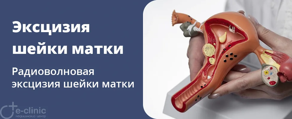 Радиоволновая эксцизия шейки матки