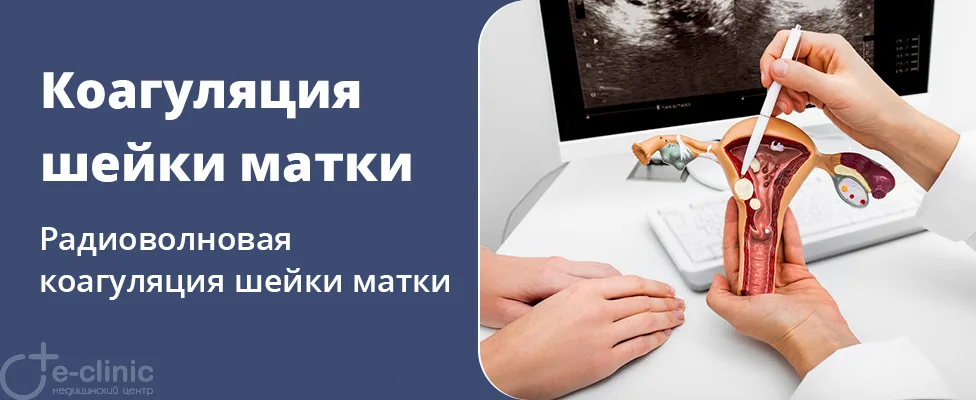 Радиоволновая коагуляция шейки матки