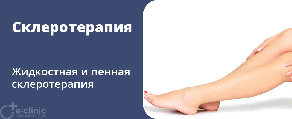 Склеротерапия