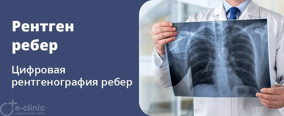 Рентген ребер